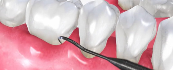 teeth-cleaning-nyc