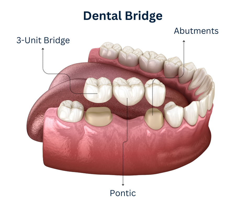 Dental Bridge Astoria