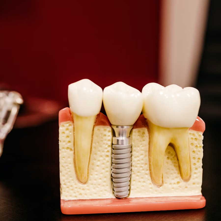 Dental Implants Astoria